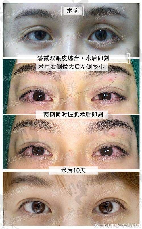 中山贝熙医疗美容医院开外眼角3800元起，精细技术打造灵动大眼效果佳
