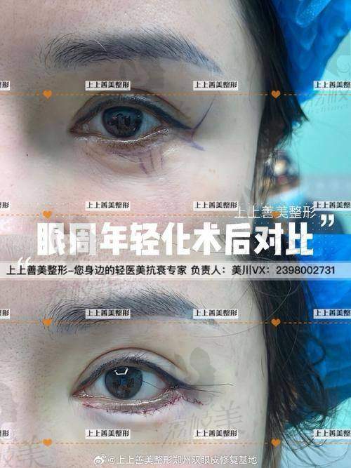 中山贝熙医疗美容医院上眼皮祛脂3800元起，重塑灵动双眸，效果惊艳技术优