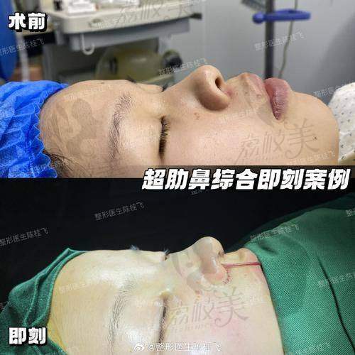 深圳张辉做鼻子怎么样？技术审美双优，术后自然稳定，赫本鼻套餐4万起惊艳来袭！