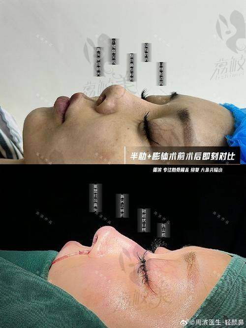 中山贝熙医疗美容医院鼻尖塑性8000元起，打造自然挺翘美鼻效果超惊艳 