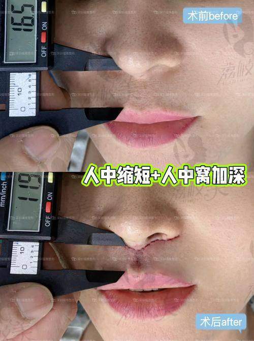 深圳福雅医疗美容医院范开防内人中缩短9800元起，精湛技术重塑精致面部比例