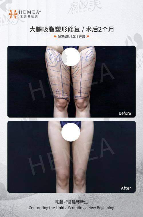 面部吸脂价格贵吗？马梅生吸脂项目价格明细来了