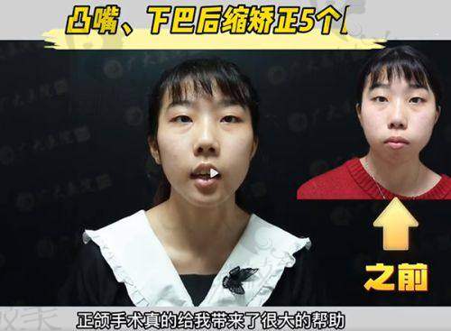 选择珠海韩妃医疗美容周国伟大腿水动力吸脂的注意事项