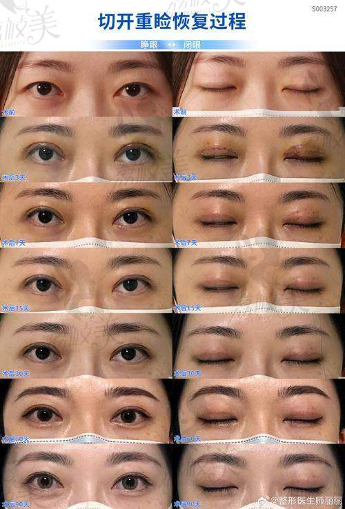 中山贝熙医疗美容医院眼综合(五项)12800元起，打造灵动美眼效果惊艳！ 