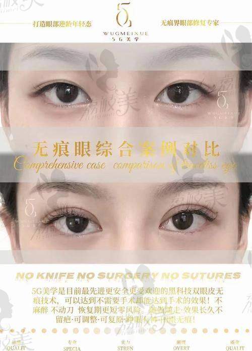 中山贝熙医疗美容医院眼综合（五项）的神奇优势