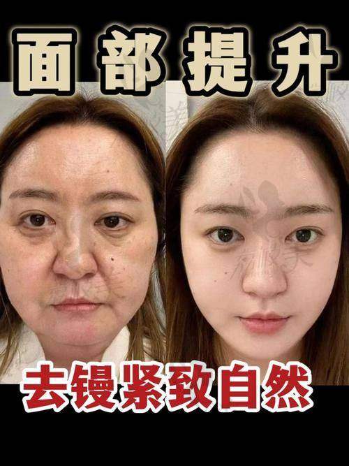 王志军SMAS除皱术+脂肪加减法真实实例解析