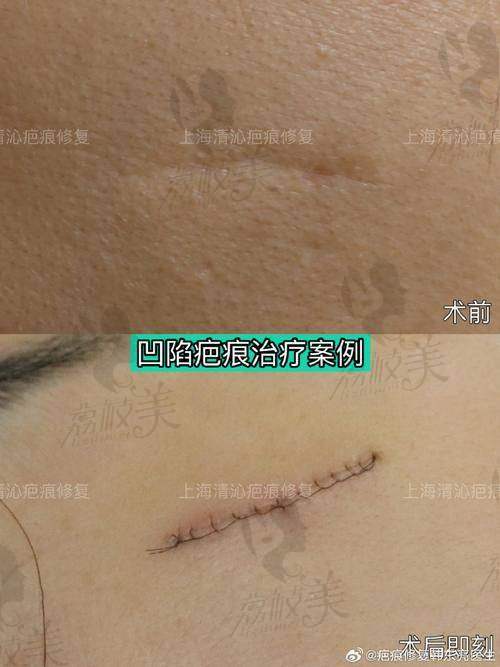 攀枝花祛疤医院排名全知道，各医院祛疤优势对比助你精准选择祛疤医院