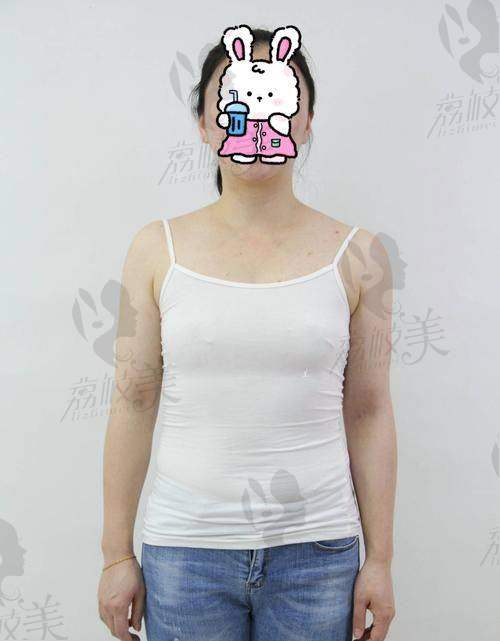 美莱夏建军曼托隆胸价格39800，胸型自然手感软糯术后跳舞都OK