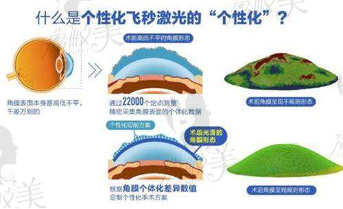 重庆南坪爱尔眼科医院 SMILE 全飞秒手术17600 元起，开启清晰视界新体验！