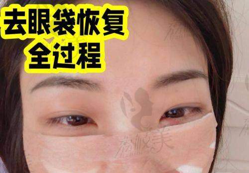 术后管理：维护“隐痕年轻”的成效秘籍