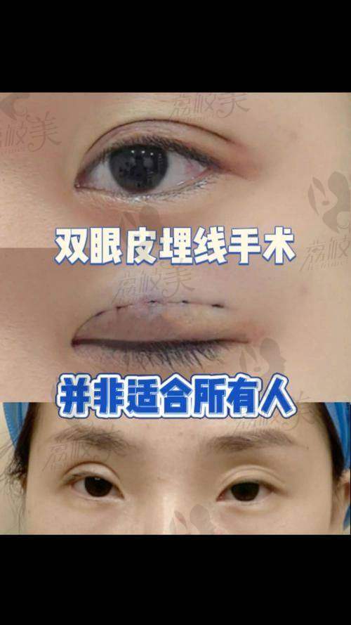 切开修复双眼皮项目解读：谁适合？咋操作？