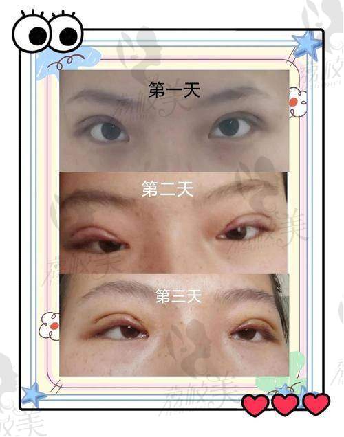 术后成效展示：电眼形态hold住全场