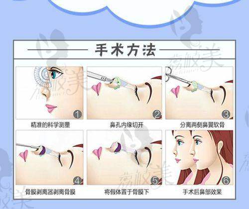揭秘中山贝熙医疗美容医院隆鼻王牌医生