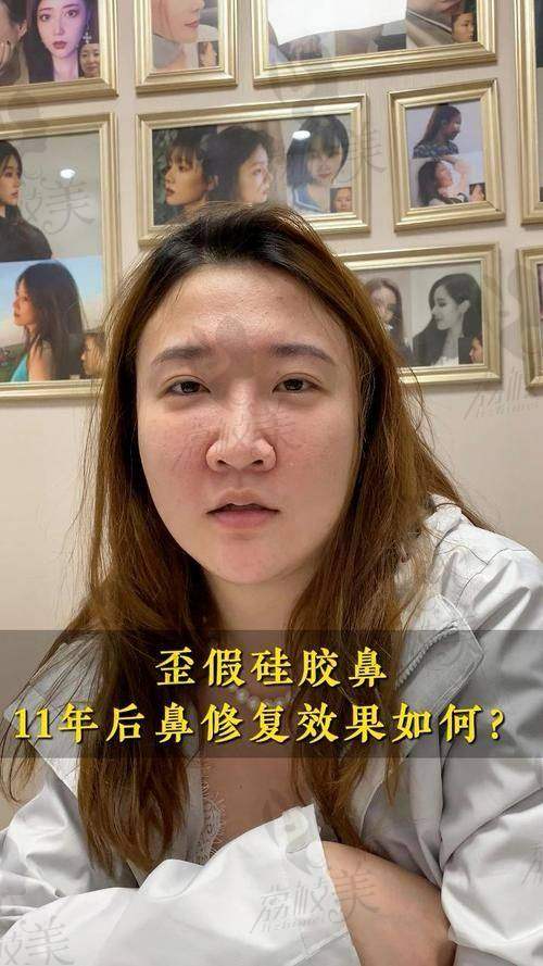 王牌医生助力：中山贝熙[医生姓名]的隆鼻魔法