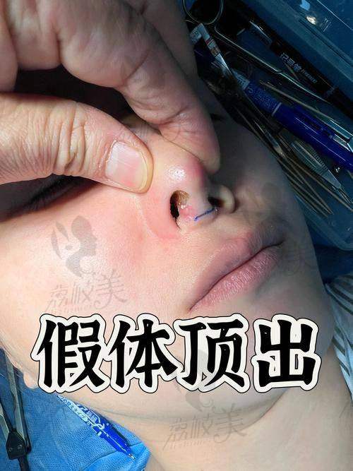 中山贝熙医疗美容医院立秀膨体假体隆鼻19800元起，塑造自然挺翘美鼻效果佳 