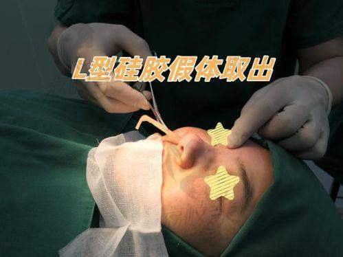 真人实例:中山贝熙医疗美容医院劳斯膨体隆鼻的神奇成效