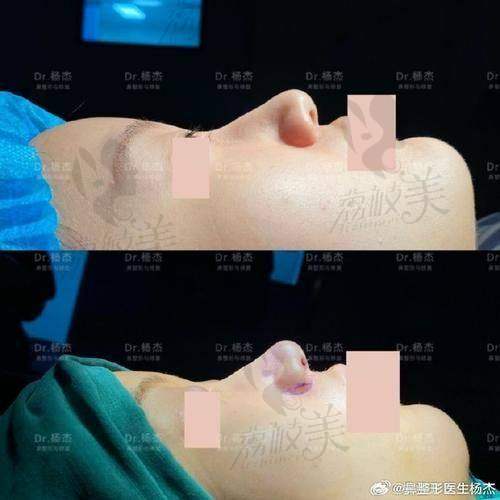 中山贝熙医疗美容医院鼻尖取注射物2800元起，专业技术助你告别注射烦恼！ 