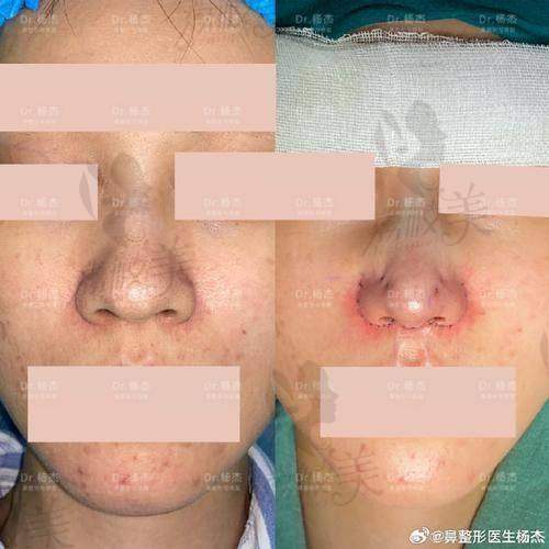 中山贝熙医院真人实例：鼻尖取注射物后的美丽蜕变