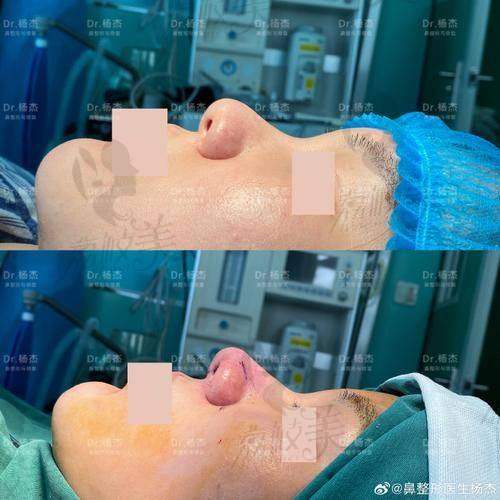 中山贝熙医院口碑爆棚：鼻尖取注射物的真实评价