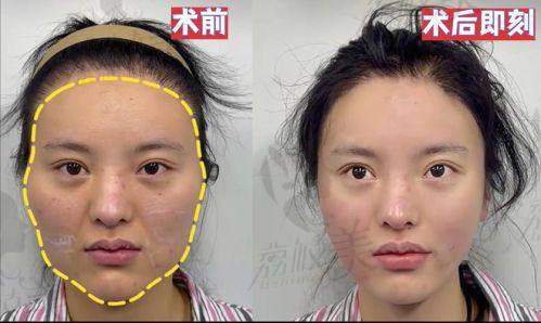 北京樱桃不开刀改脸型有哪些技术优势？