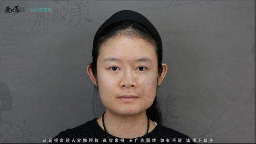 北京樱桃不开刀改脸型价格是多少？