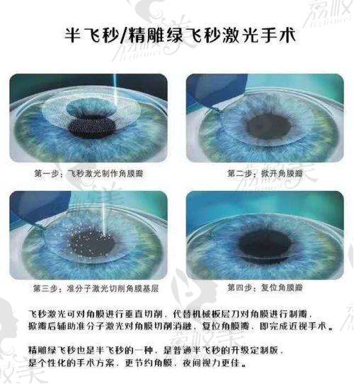 二、精良的手术技术——精细化雕刻Q+半飞秒
