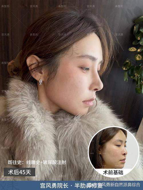 中山贝熙医疗美容医院二次鼻修复：优势特色大揭秘