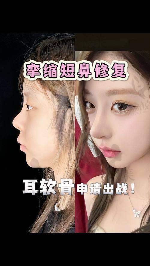 中山贝熙医疗美容医院二次鼻修复：口碑评价超棒