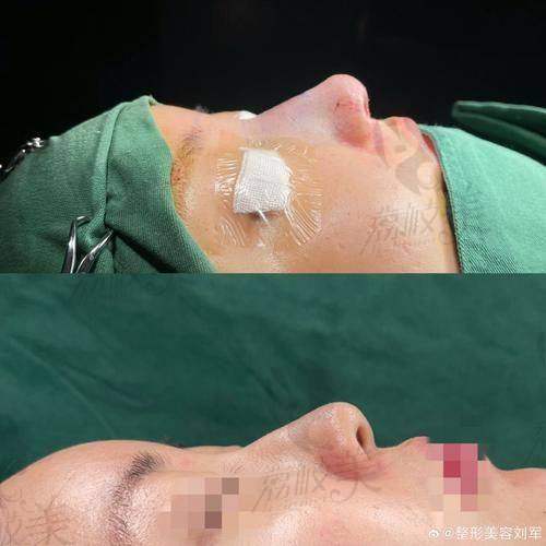 中山贝熙医疗美容医院二次鼻修复45000元起，重塑美鼻效果惊艳，精湛技术受赞誉 
