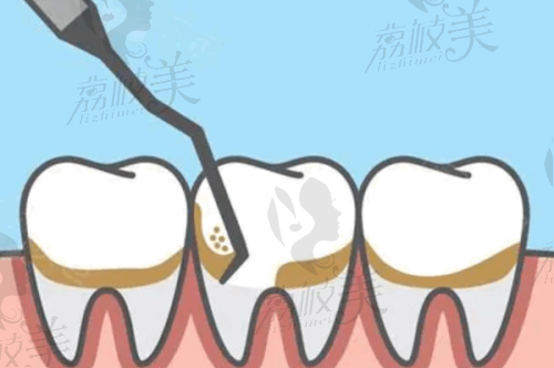 西安諾貝爾口腔醫(yī)院補(bǔ)牙費(fèi)用價(jià)格低至980元起，輕松解決牙洞煩惱還你燦爛笑容