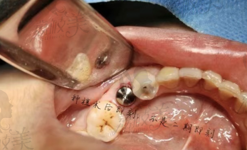 關于種牙、矯正、牙齒美容，清木貴嗎？