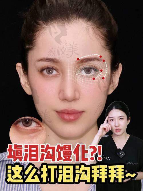 上海艺星医疗美容医院：泪沟1+1定制方案，术后即刻见效