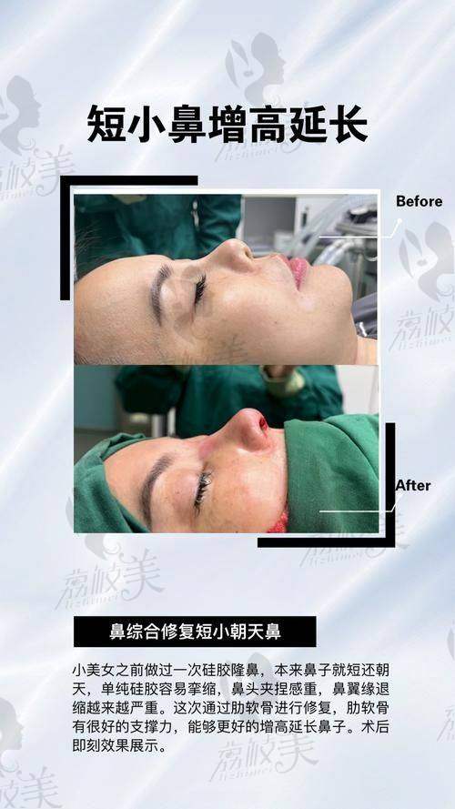 中山贝熙医疗美容医院膨体双侧耳软骨综合鼻三项膨体鼻综合19800元起，打造自然挺翘美鼻 