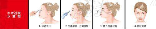 别再犹豫，中山贝熙膨体鼻综合带你开启美鼻之旅