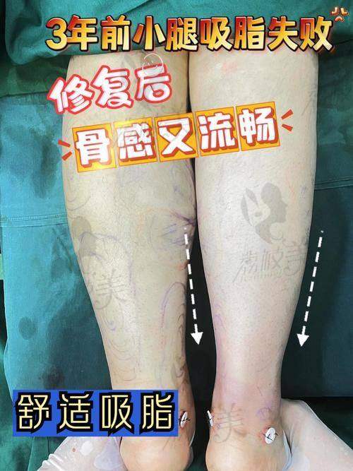 关于“吸脂后反弹”的担忧,听听医生怎么说