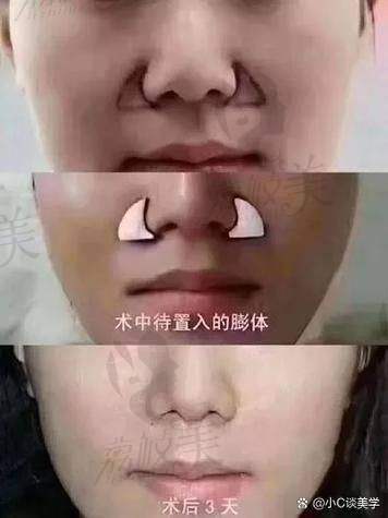 中山貝熙口碑爆棚：硅膠鼻基底填充好評如潮！
