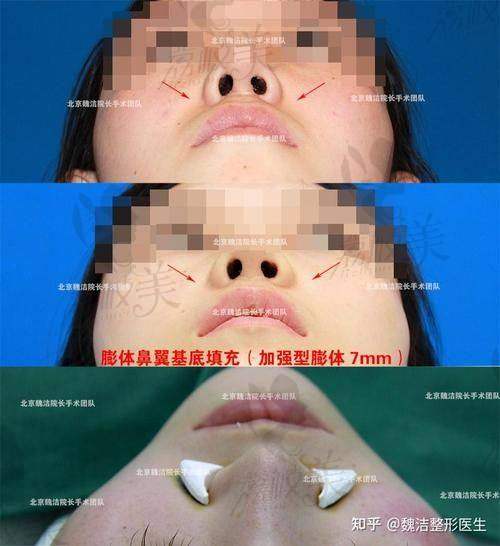真人實例見證：中山貝熙硅膠鼻基底填充，成效驚艷到尖叫！