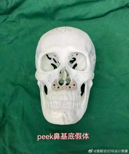 別再猶豫啦！中山貝熙硅膠鼻基底填充 12800 元起，趕緊沖！