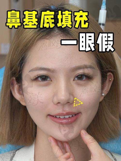 中山貝熙醫(yī)療美容醫(yī)院硅膠鼻基底填充12800元起，重塑面部立體美感效果超驚艷 