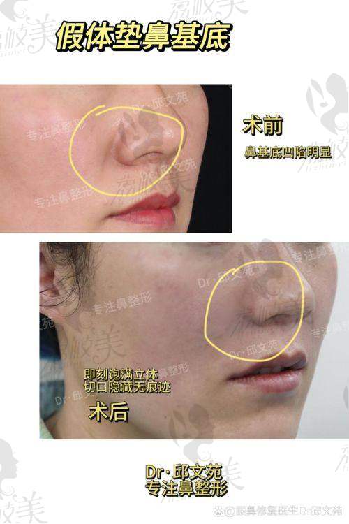 中山貝熙醫(yī)療美容醫(yī)院膨體鼻基底填充19800元起，重塑立體面中，打造自然高級(jí)感