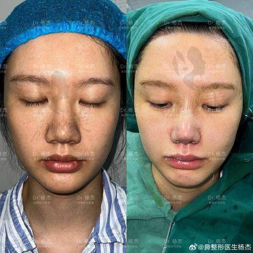 中山貝熙鼻尖取軟骨：開啟美麗新旅程