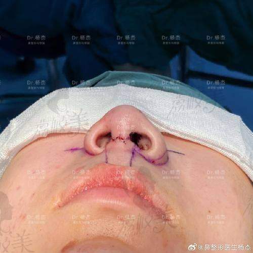 中山貝熙醫(yī)療美容醫(yī)院鼻尖取鼻中隔軟骨16000元起，塑造自然挺翹美鼻效果超驚艷 