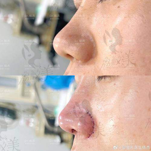 中山貝熙鼻尖取軟骨：技術(shù)優(yōu)勢(shì)大揭秘