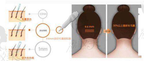 朱秀红医生在不剃发植发领域有何优势？