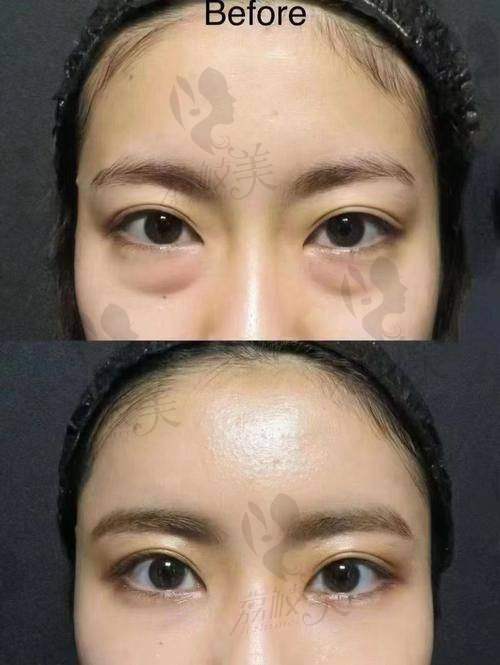 北京闫立新医生祛眼袋多少钱？独特技术价格透明，术后满意度超高！