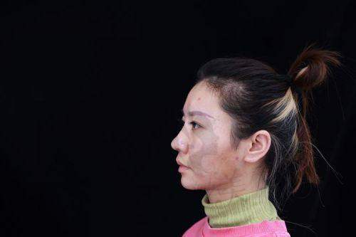 筋膜包裹技术：术后鼻子不透光，柔软有手感