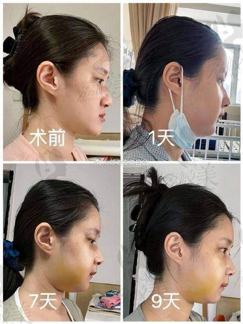 中山贝熙膨体+肋软骨鼻综合：技术优势大揭秘