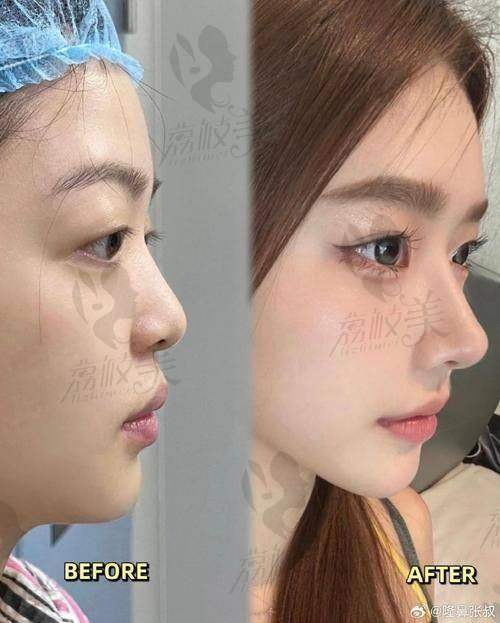 真人实例：见证中山贝熙美鼻奇迹