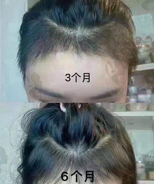 天津熙朵医院在发际线种植方面有哪些特色？