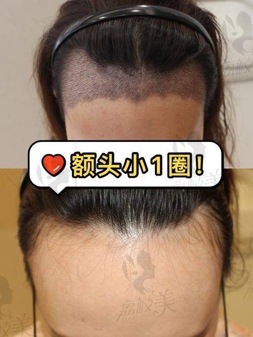 进行发际线种植前需要做哪些准备？